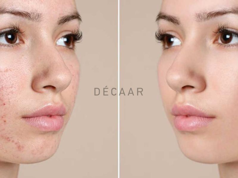 các loại peel da